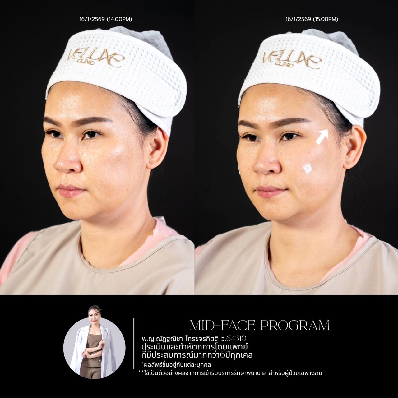 Filler ใต้ตา