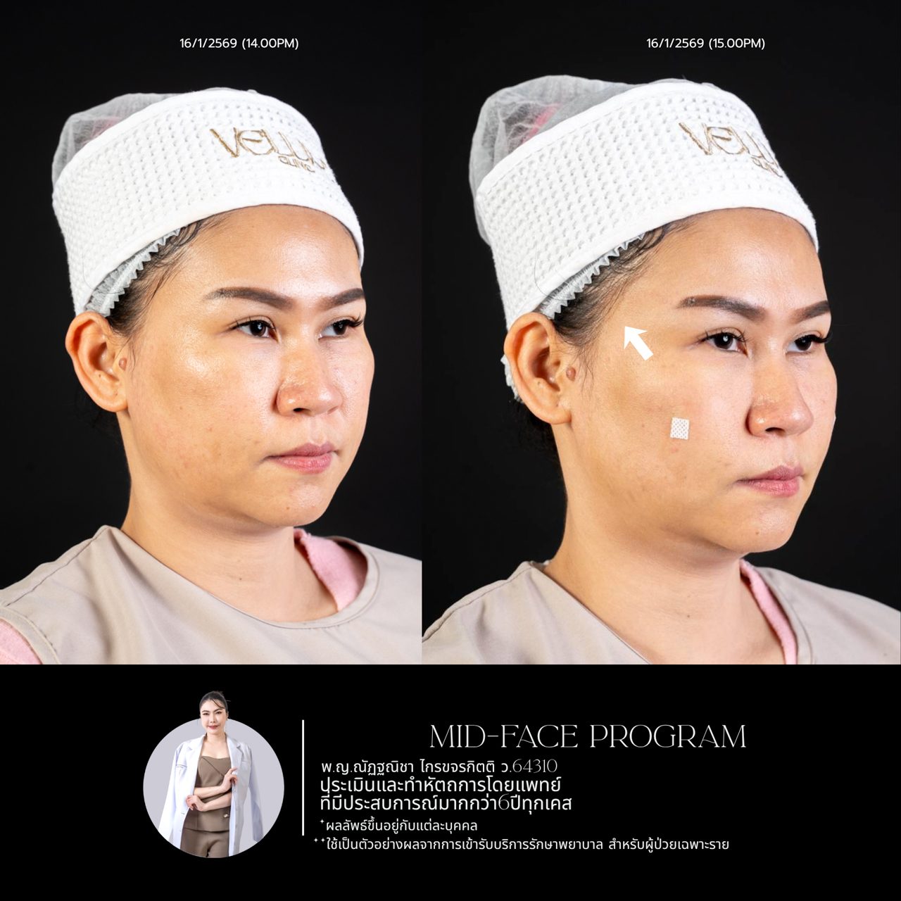 Filler ใต้ตา