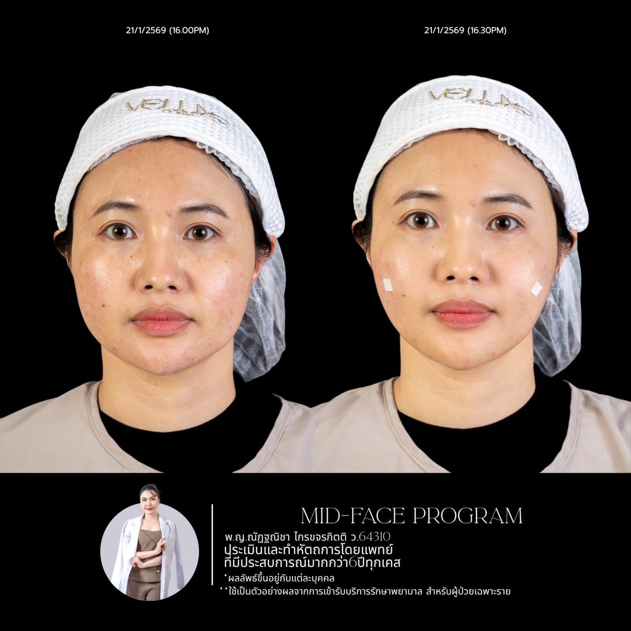 Filler ใต้ตา