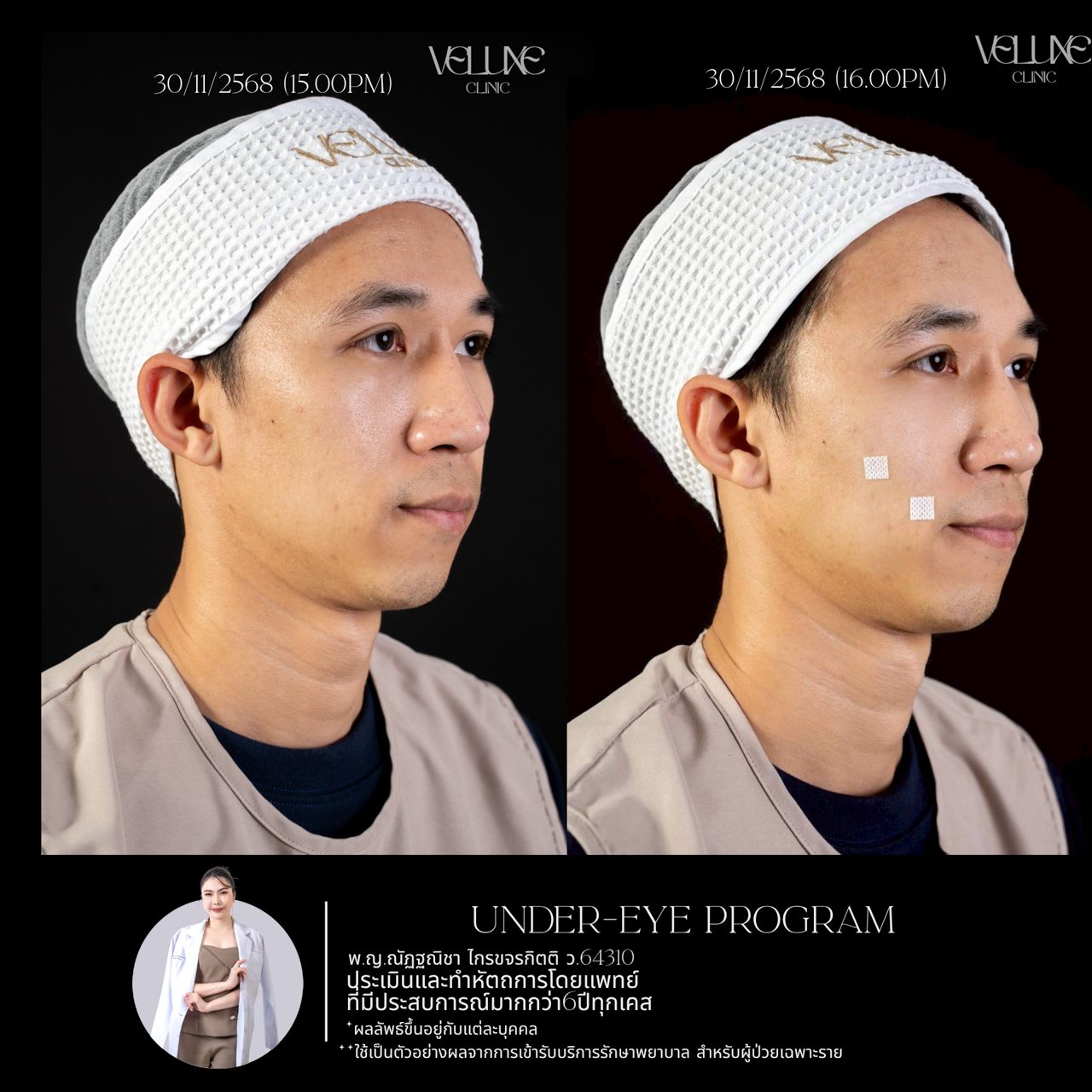 Filler ใต้ตา