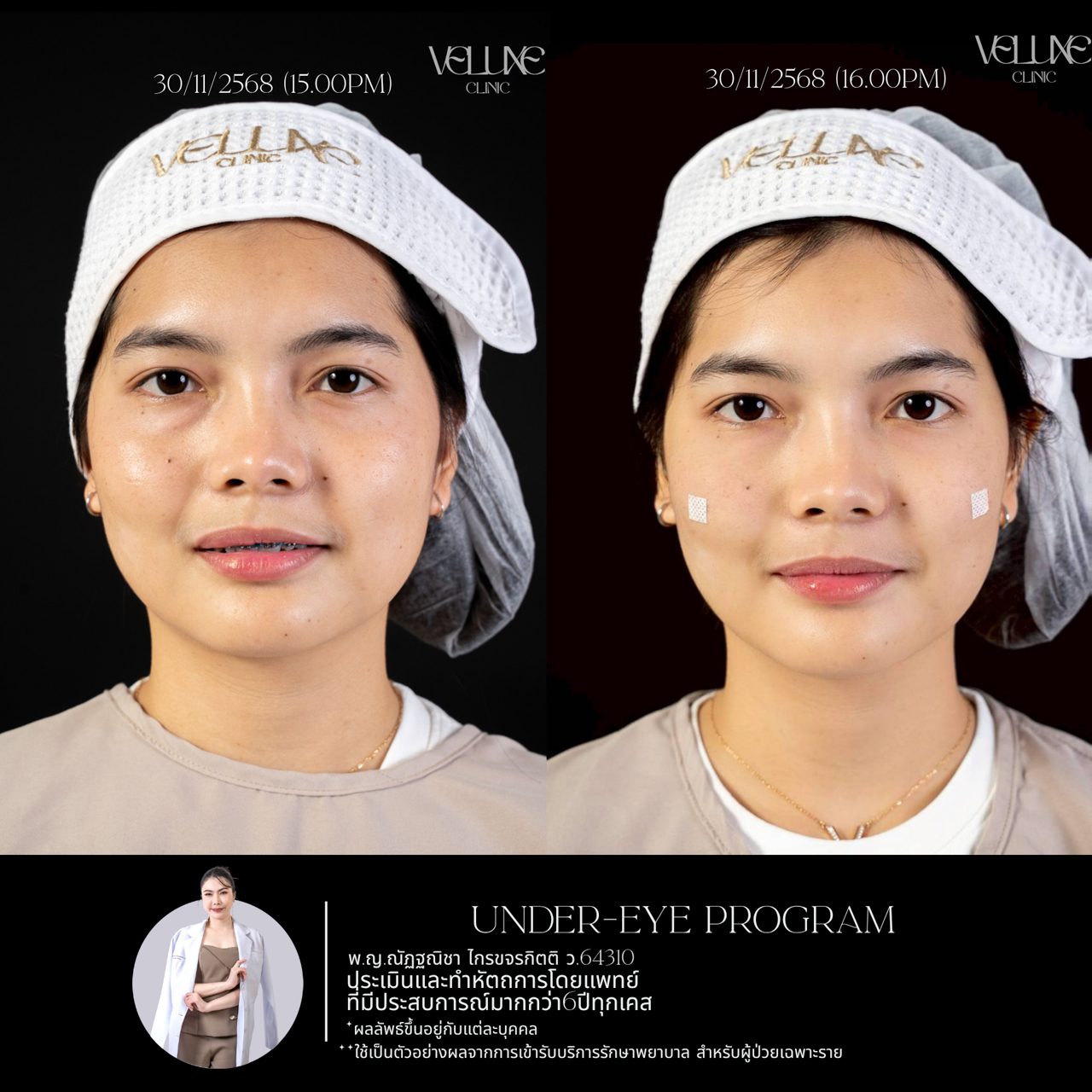 Filler ใต้ตา