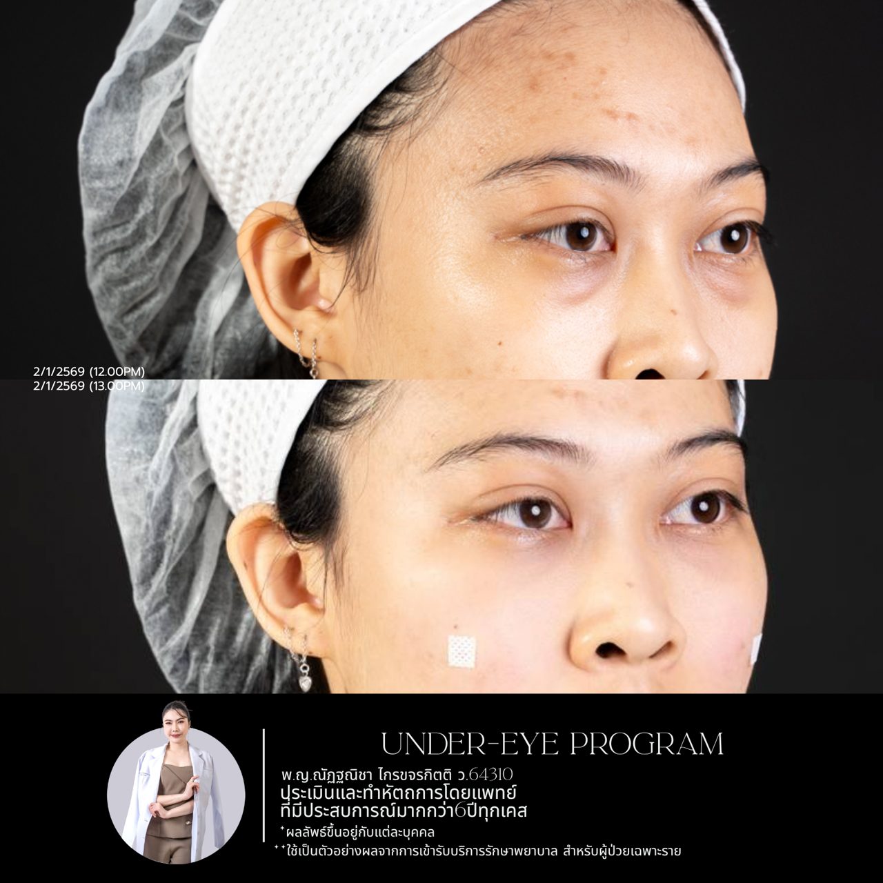 Filler ใต้ตา