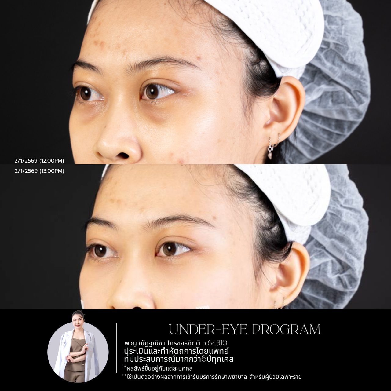 Filler ใต้ตา