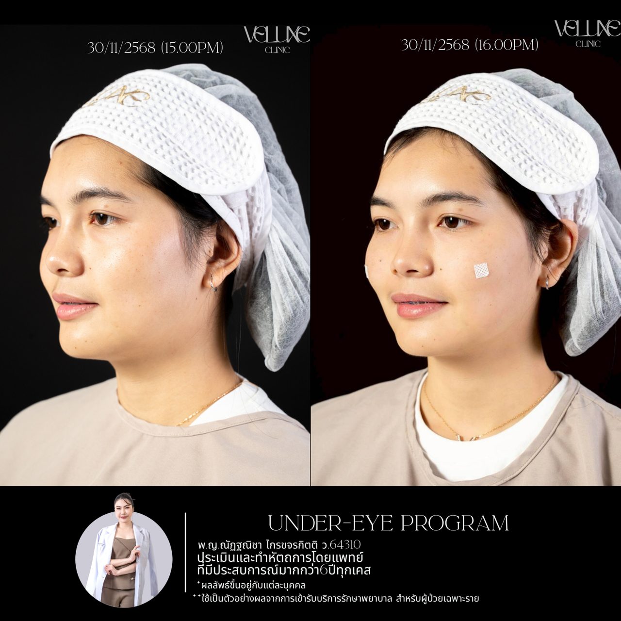 Filler ใต้ตา