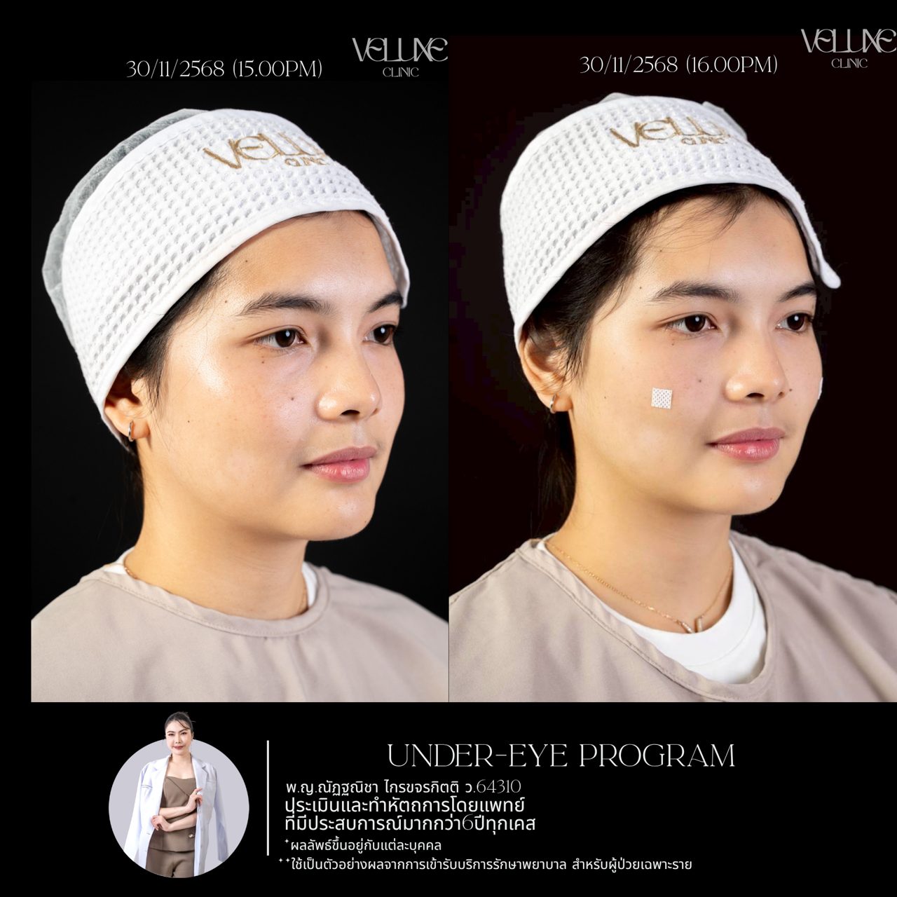 Filler ใต้ตา