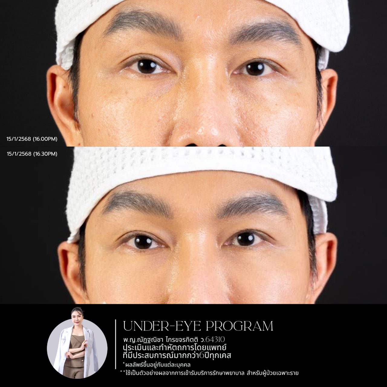 Filler ใต้ตา