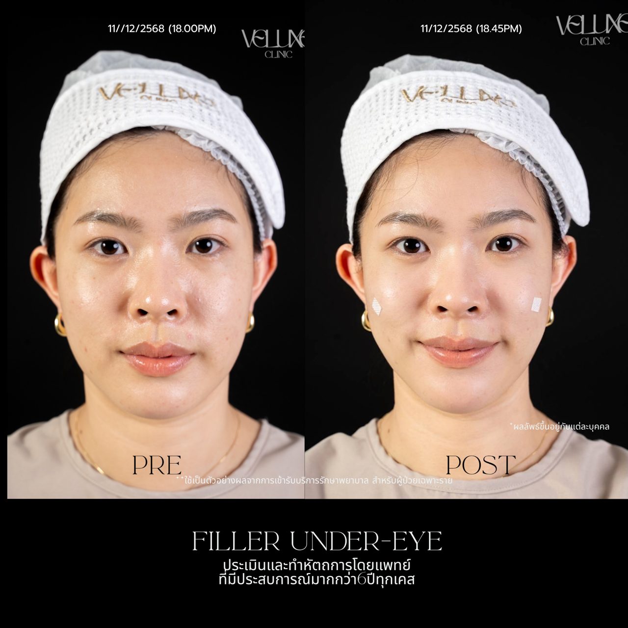 Filler ใต้ตา