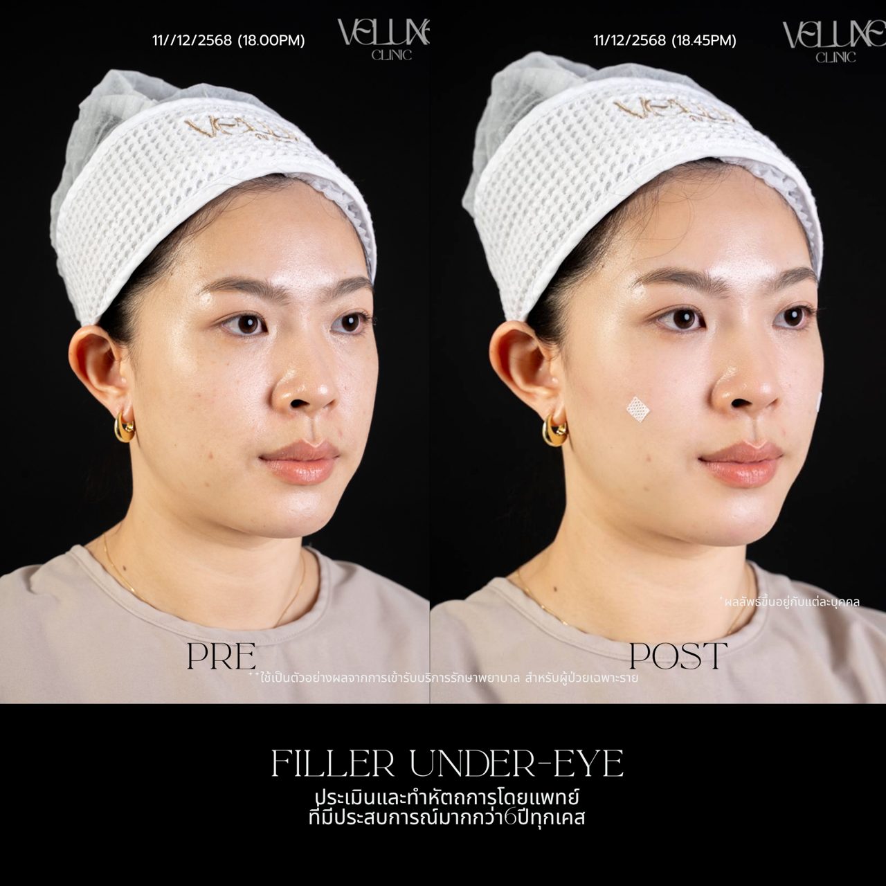 Filler ใต้ตา