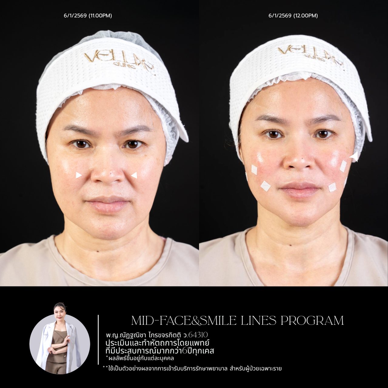 Filler ใต้ตา