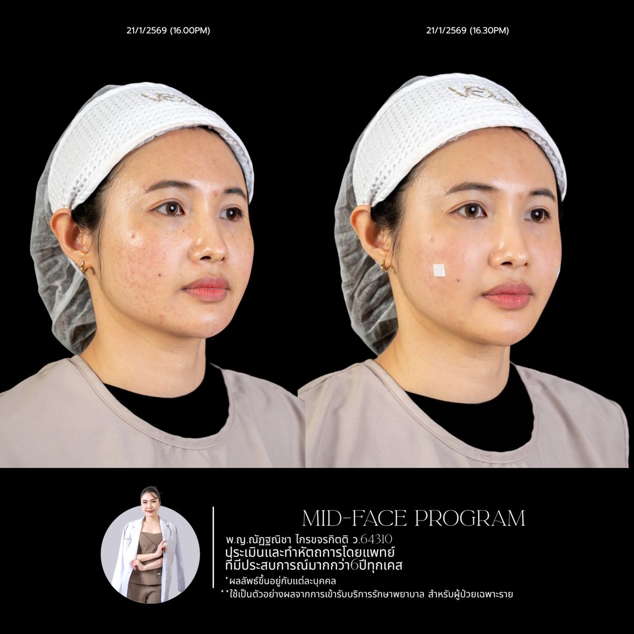 Filler ใต้ตา