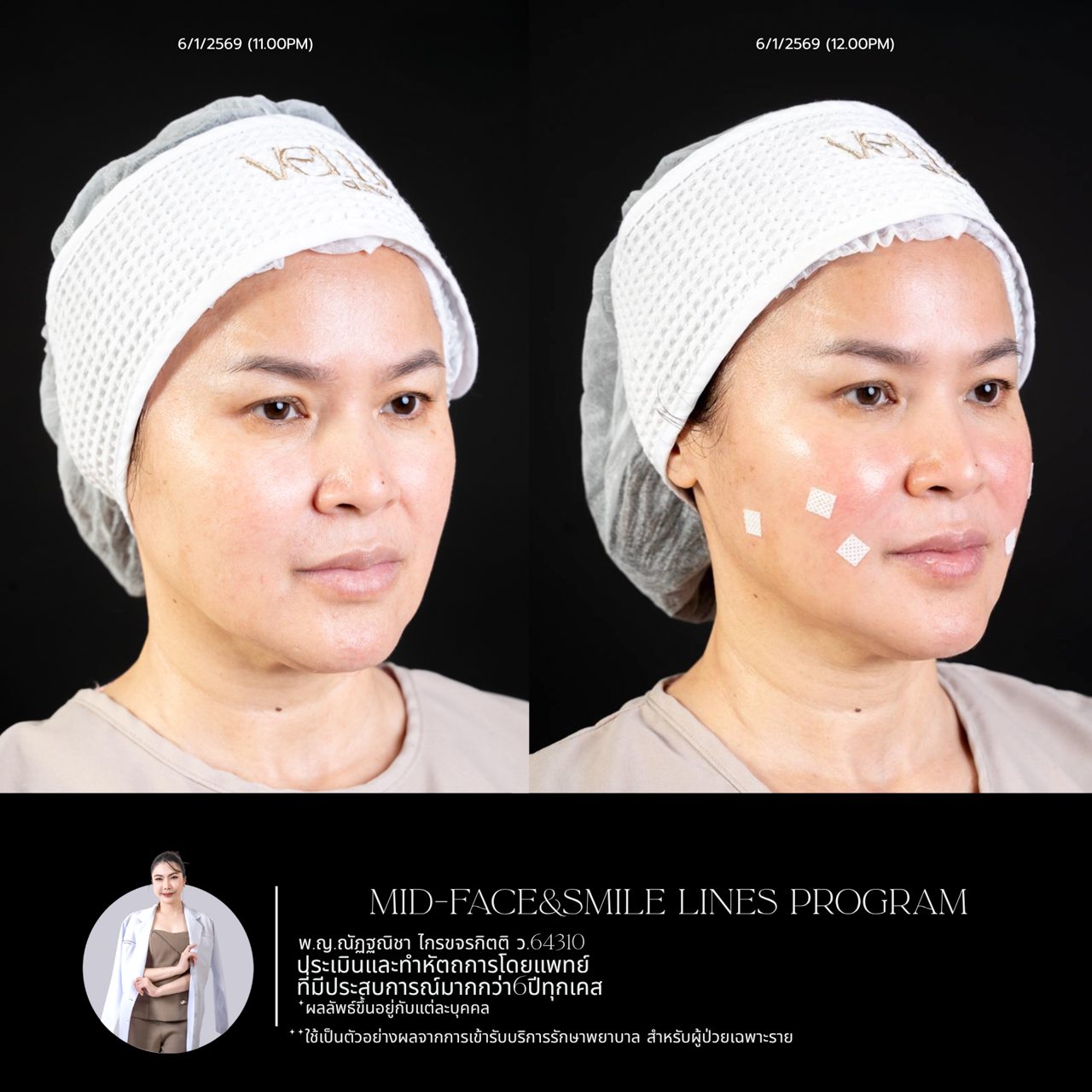 Filler ใต้ตา