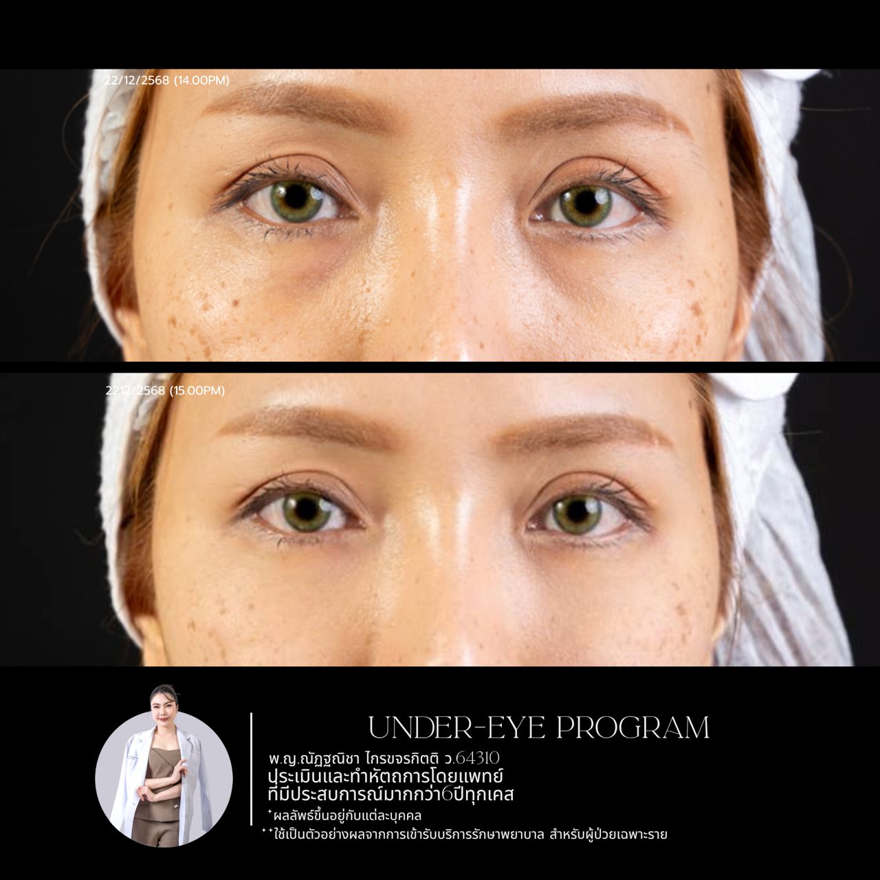 Filler ใต้ตา