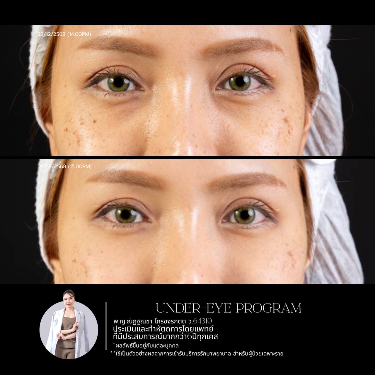 Filler ใต้ตา