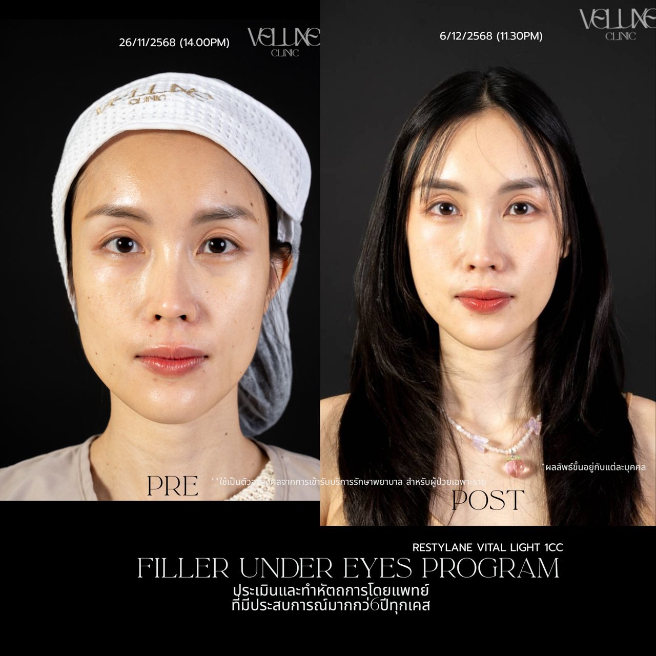 Filler ใต้ตา
