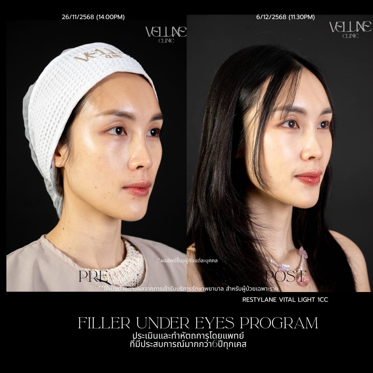 Filler ใต้ตา