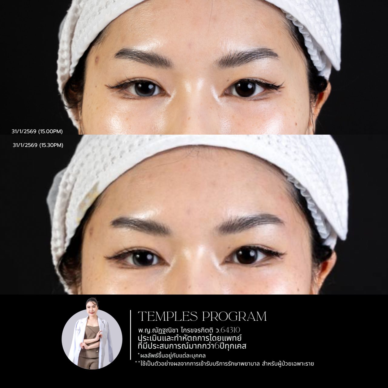 Filler ใต้ตา