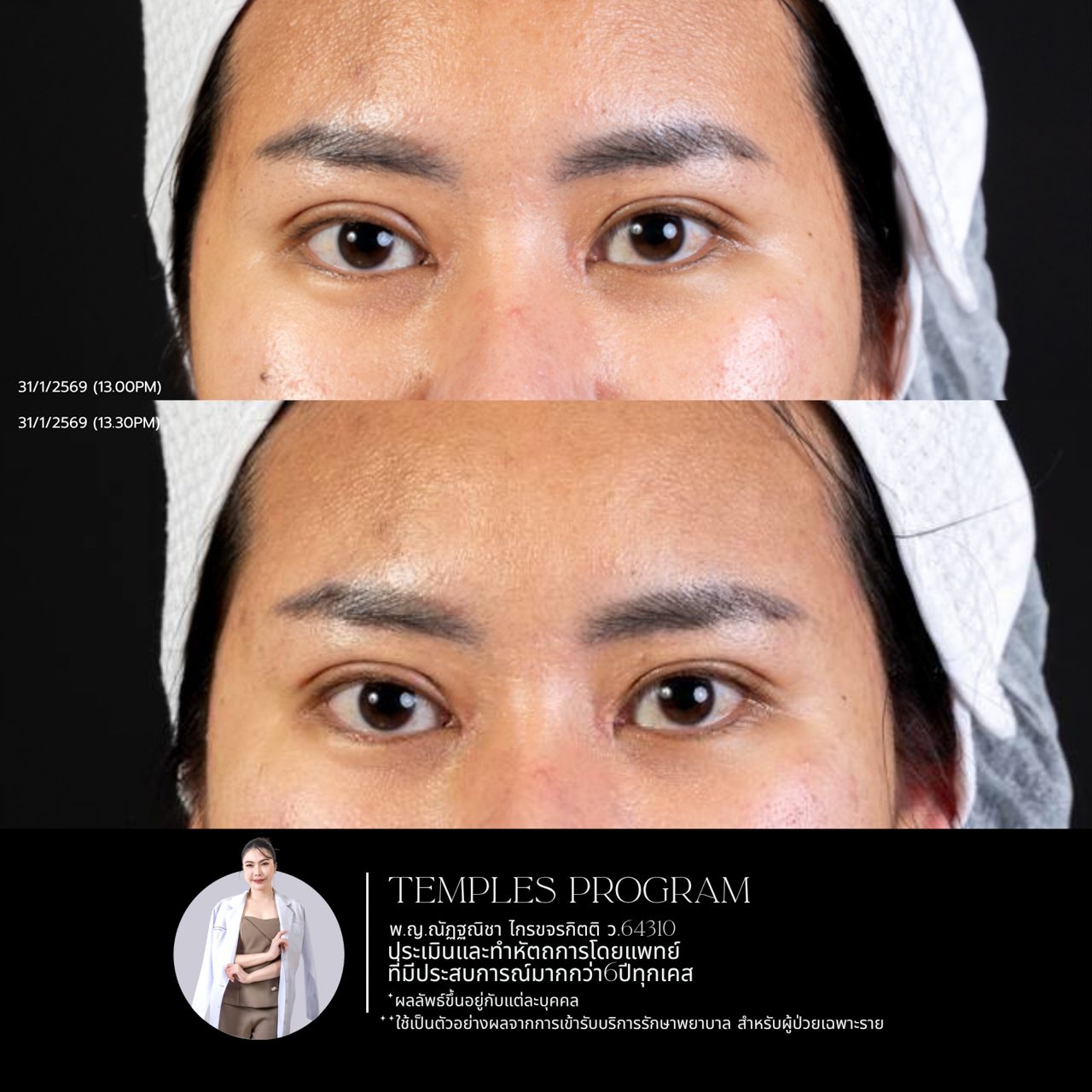 Filler ใต้ตา