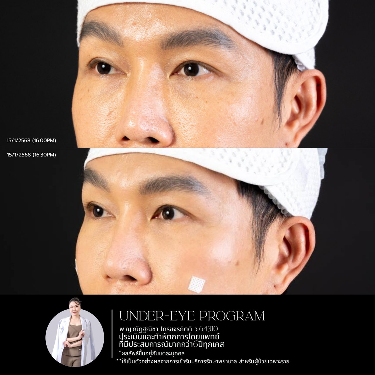 Filler ใต้ตา