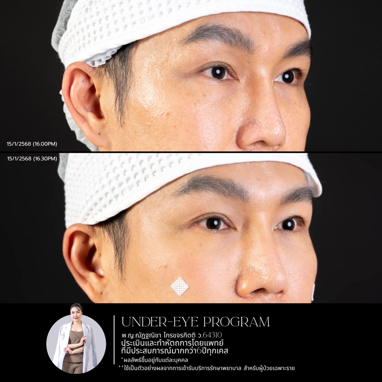 Filler ใต้ตา