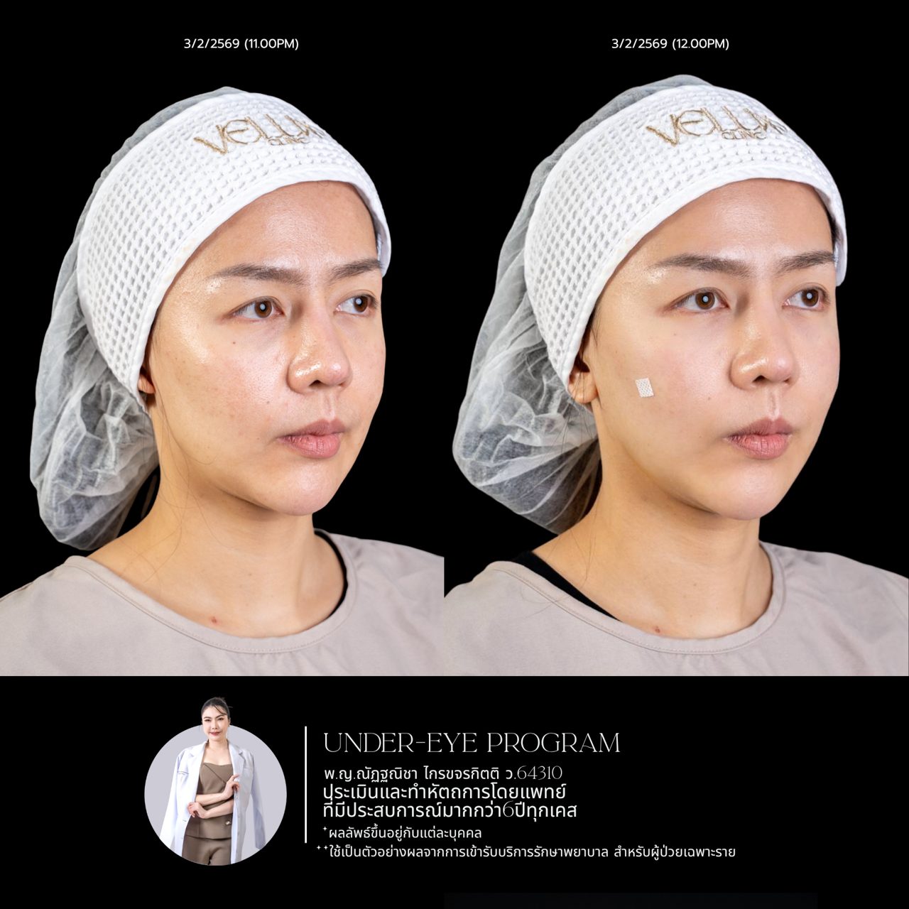 Filler ใต้ตา