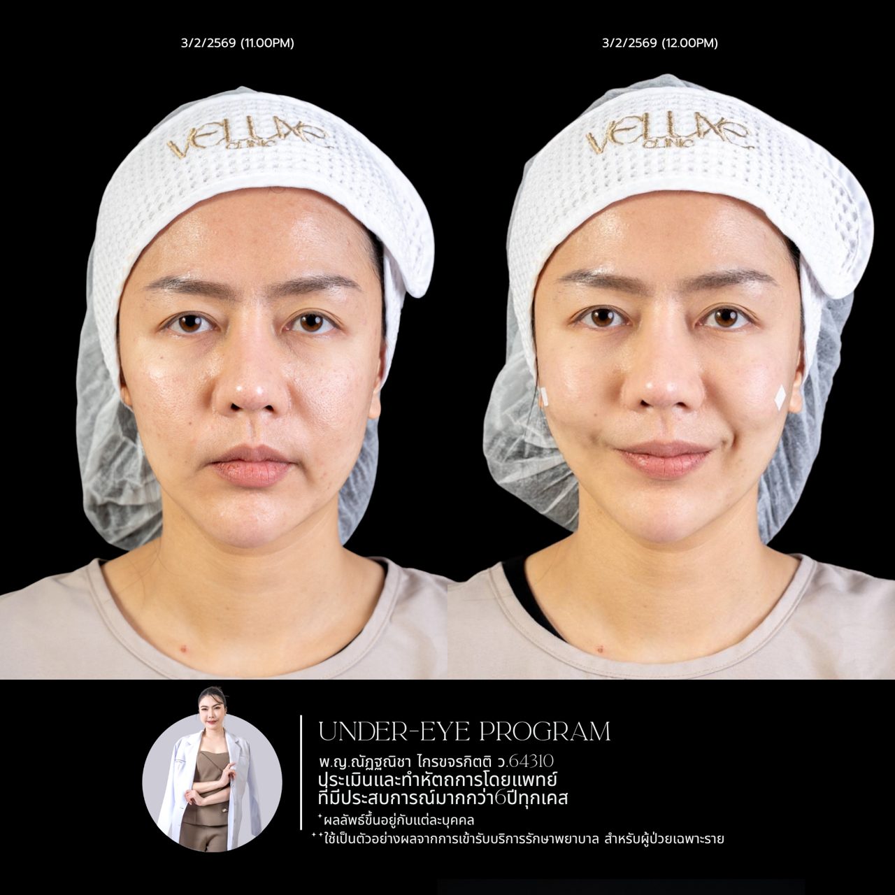 Filler ใต้ตา