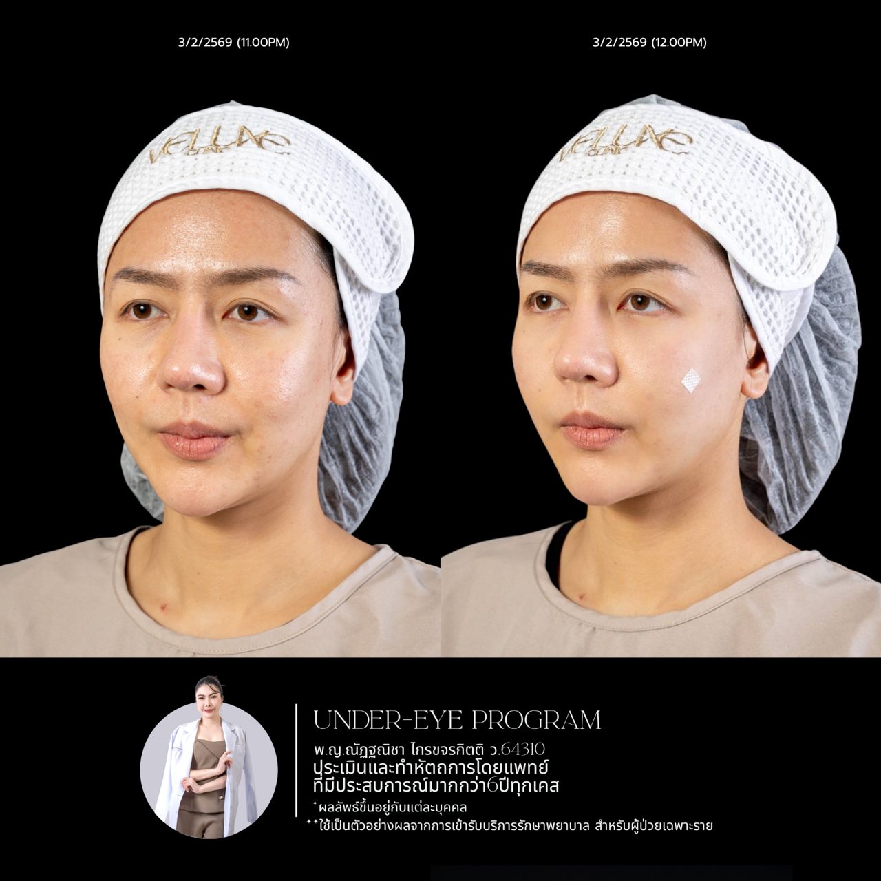 Filler ใต้ตา