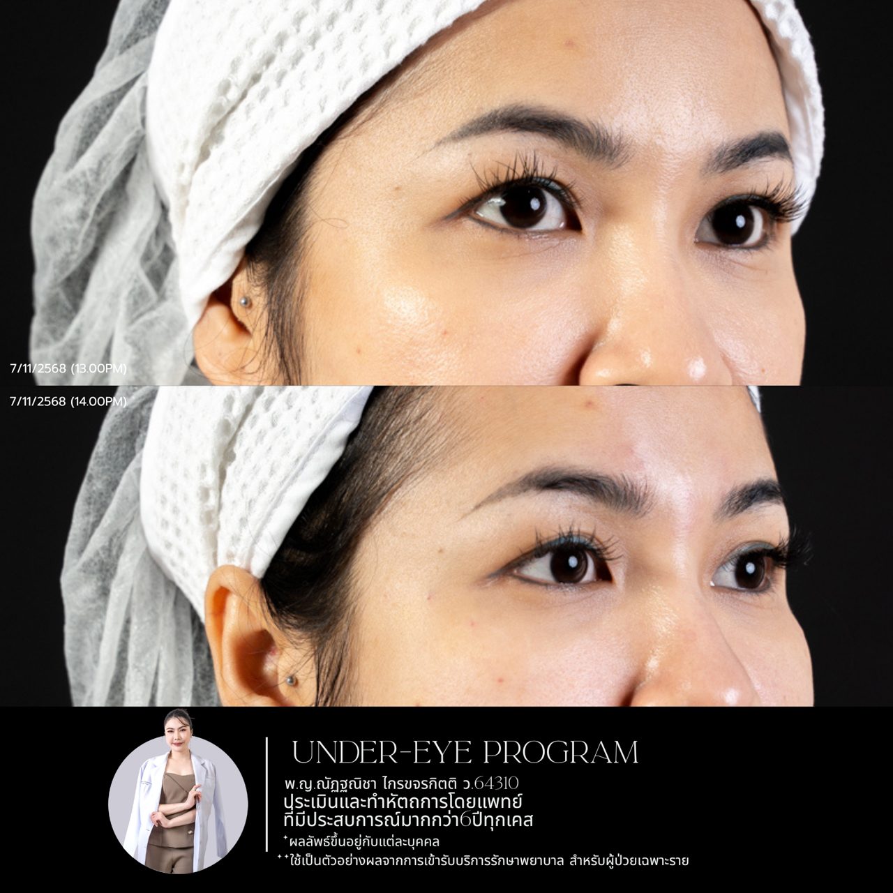 Filler ใต้ตา
