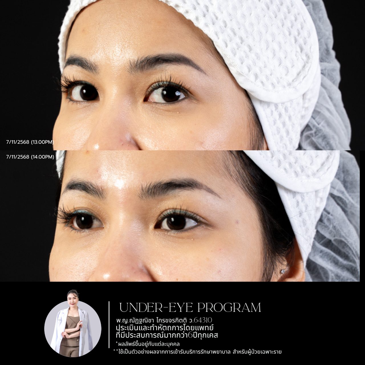 Filler ใต้ตา
