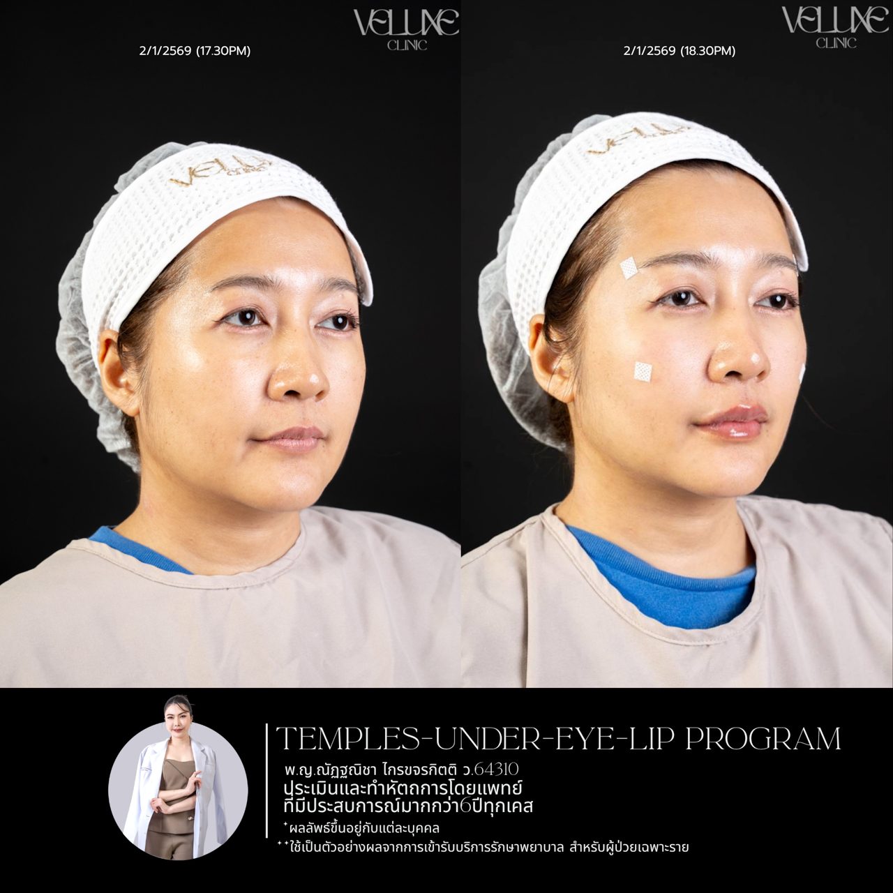 Filler ใต้ตา