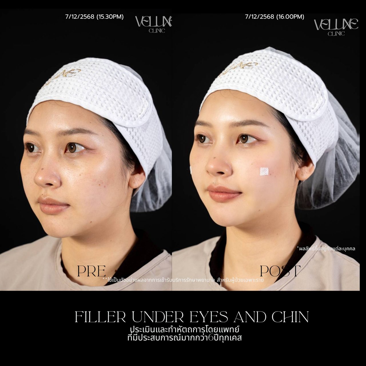 Filler ใต้ตา