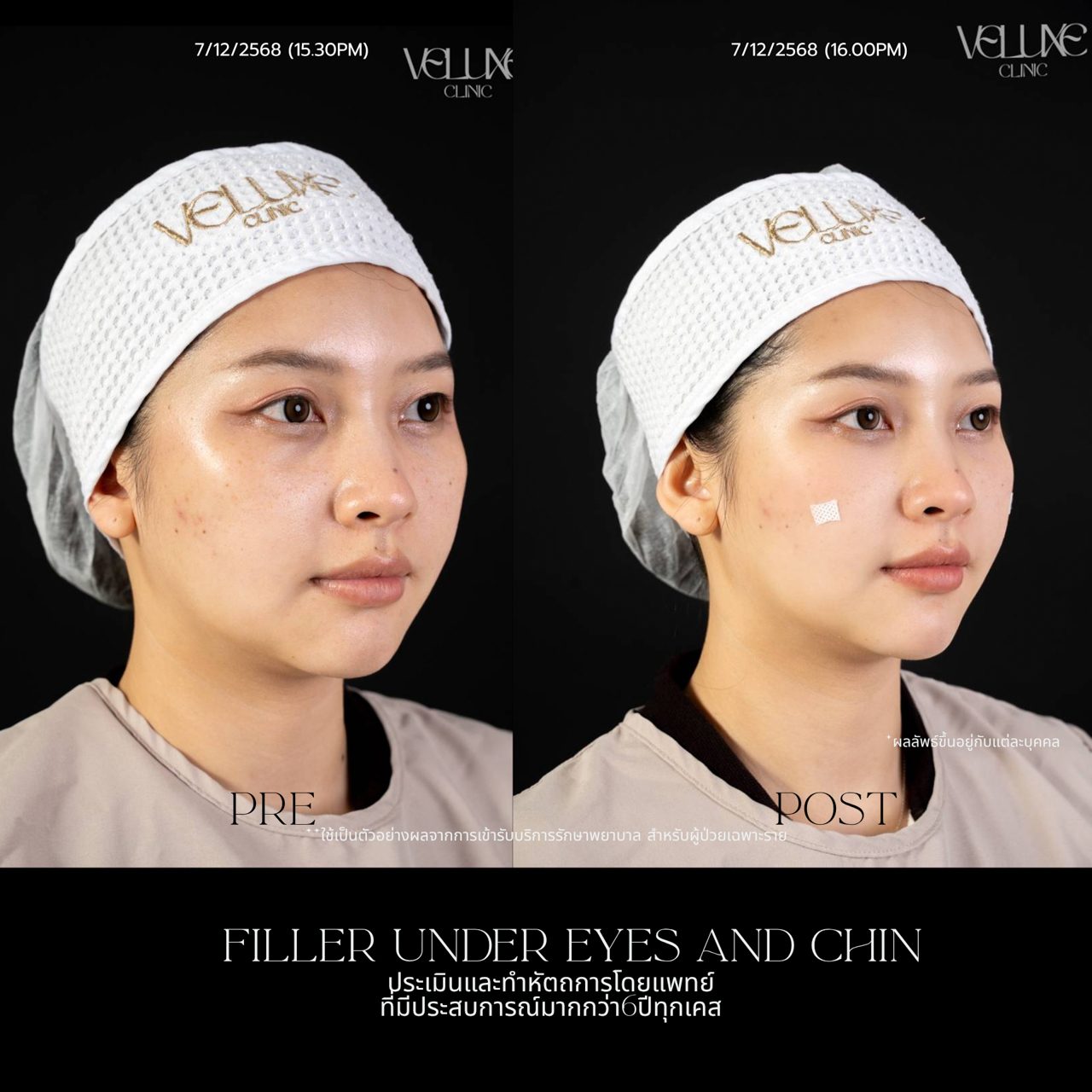 Filler ใต้ตา