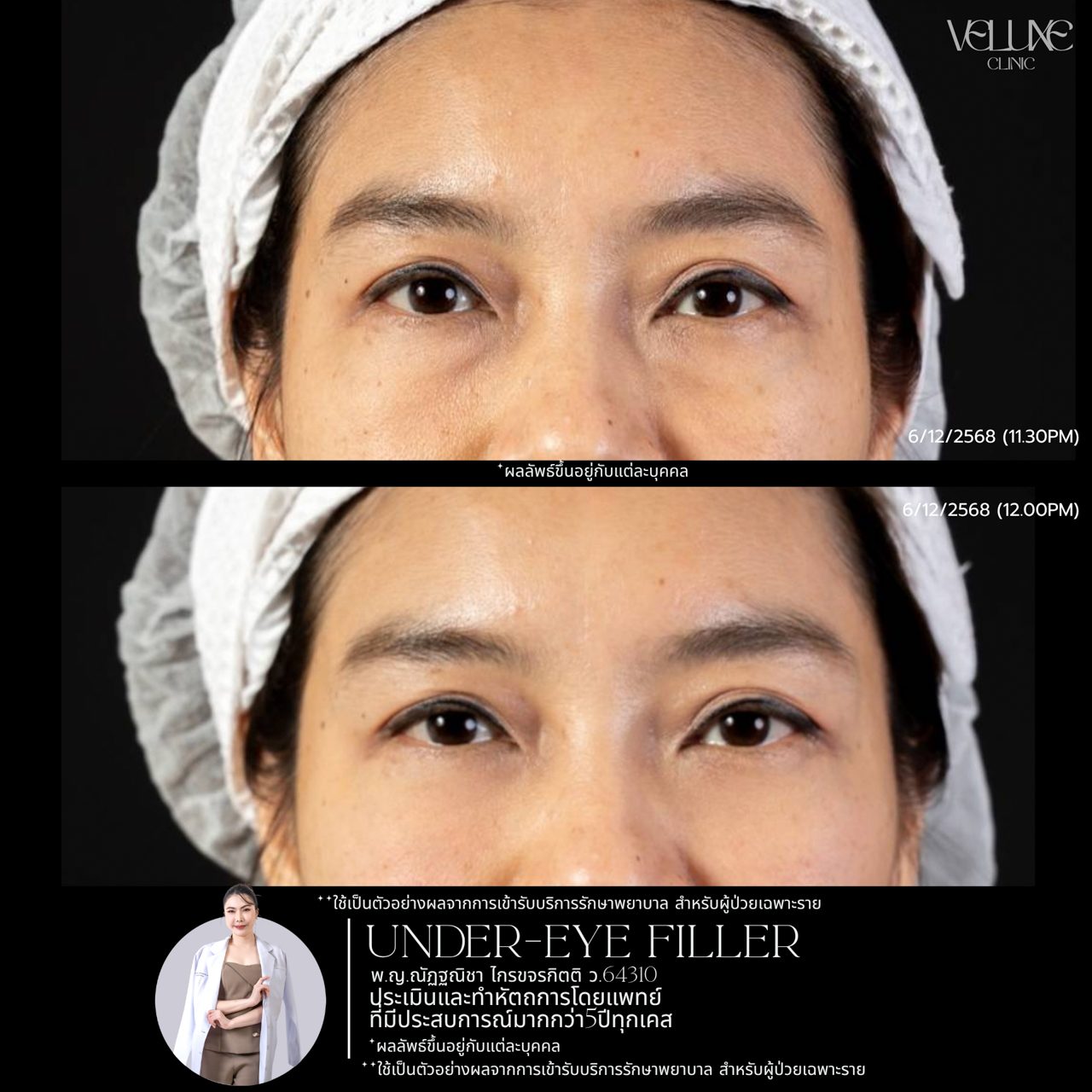 Filler ใต้ตา