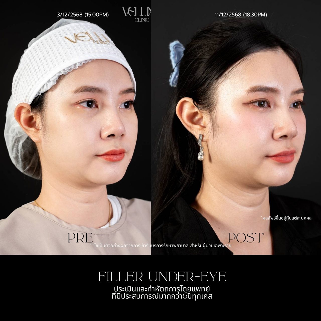 Filler ใต้ตา