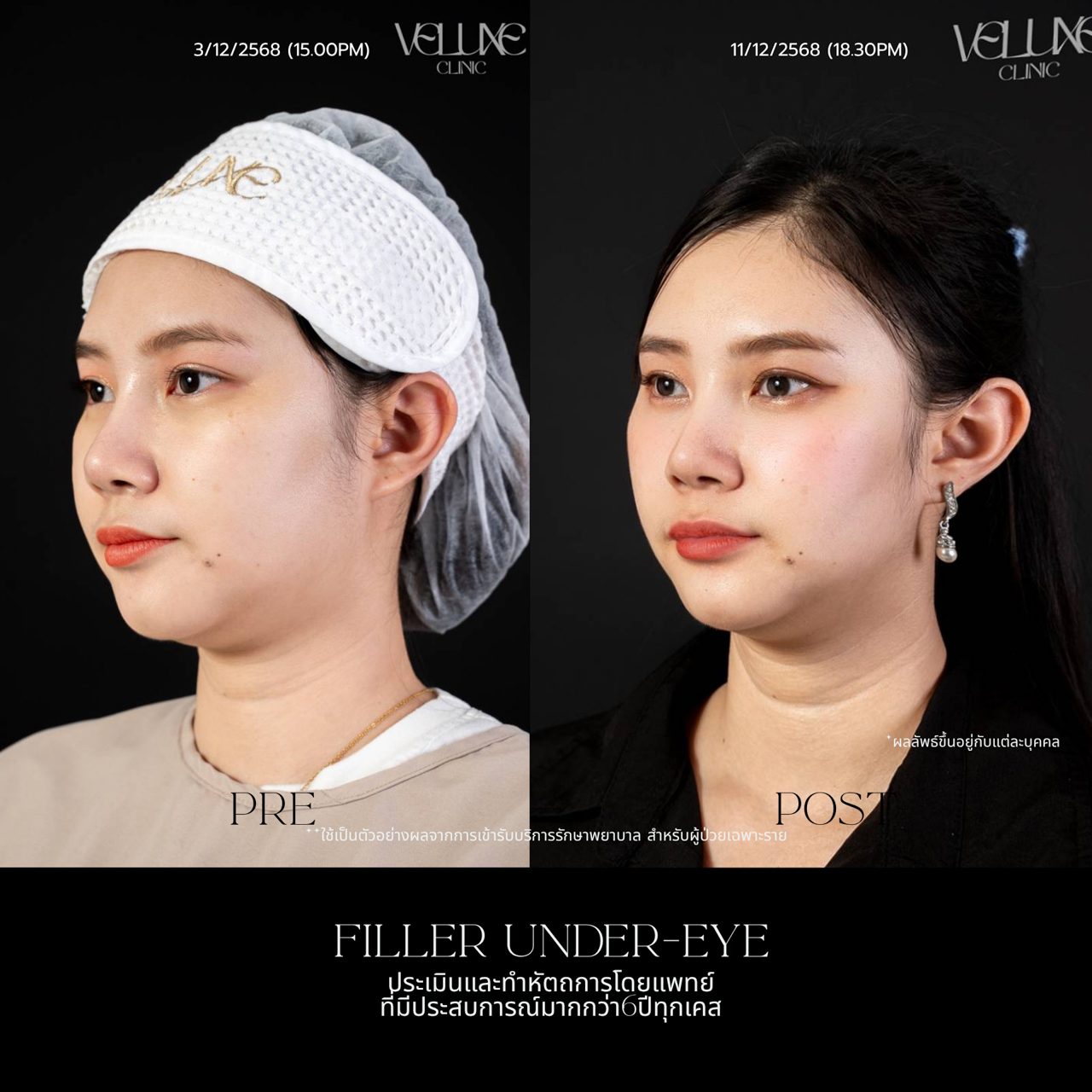 Filler ใต้ตา
