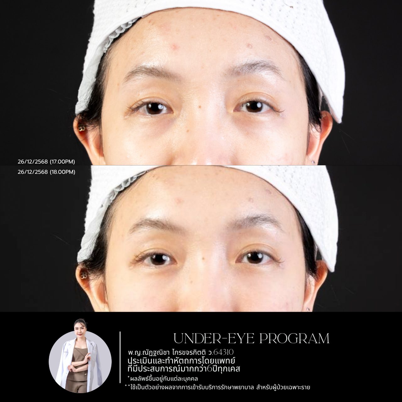 Filler ใต้ตา