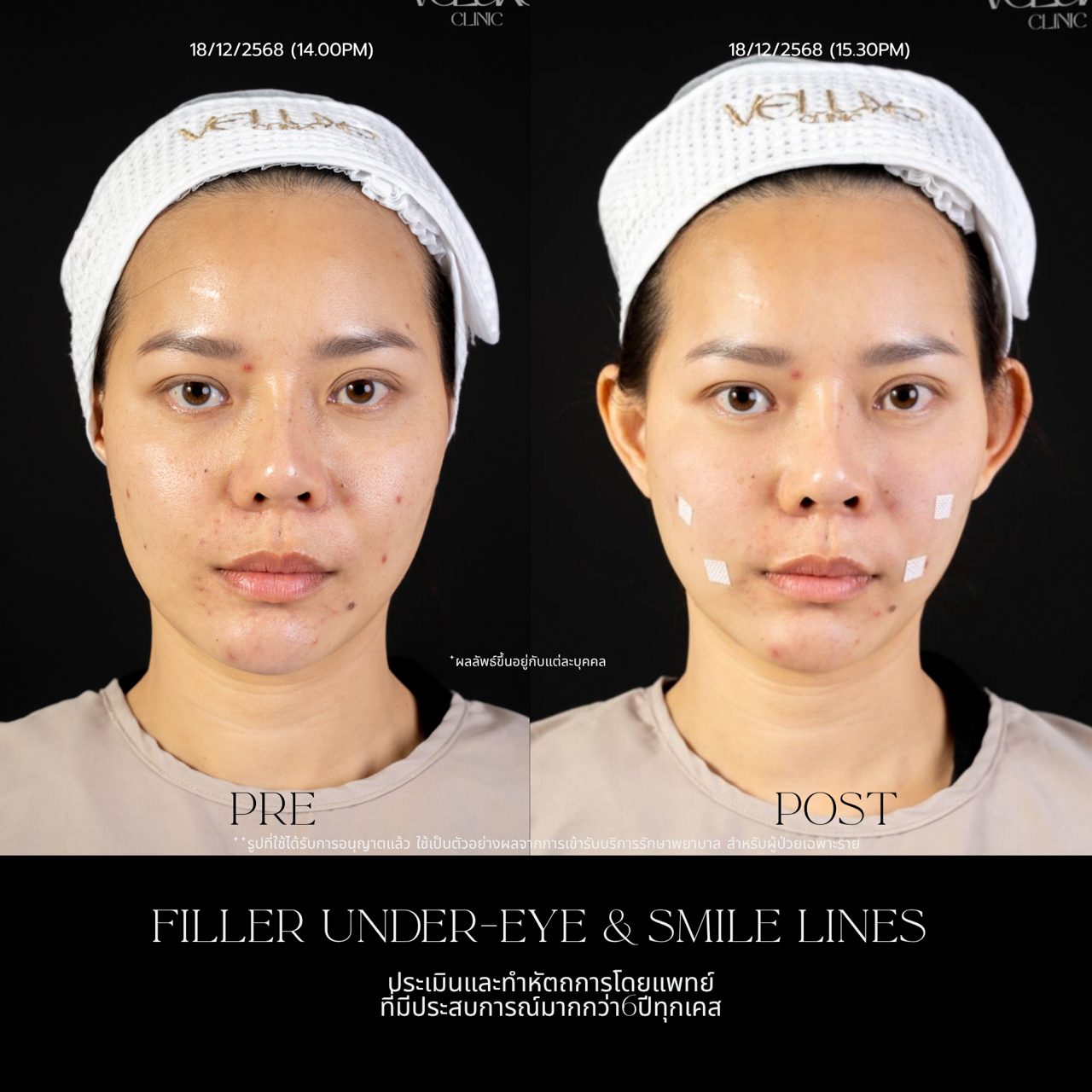 Filler ใต้ตา