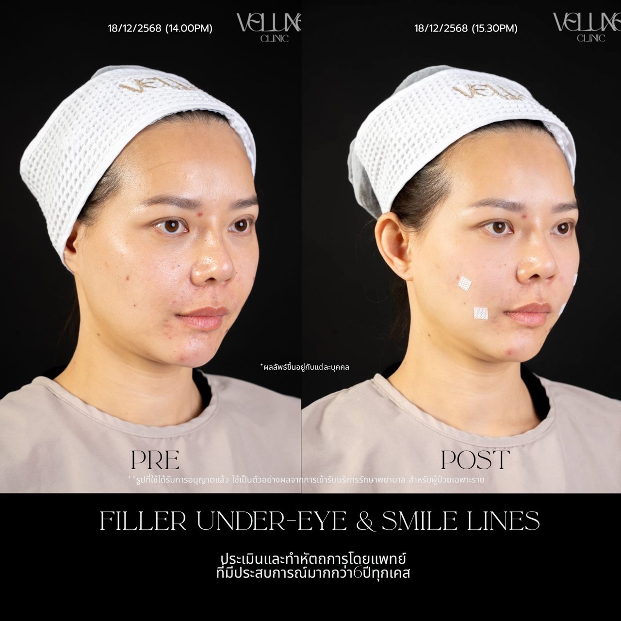 Filler ใต้ตา
