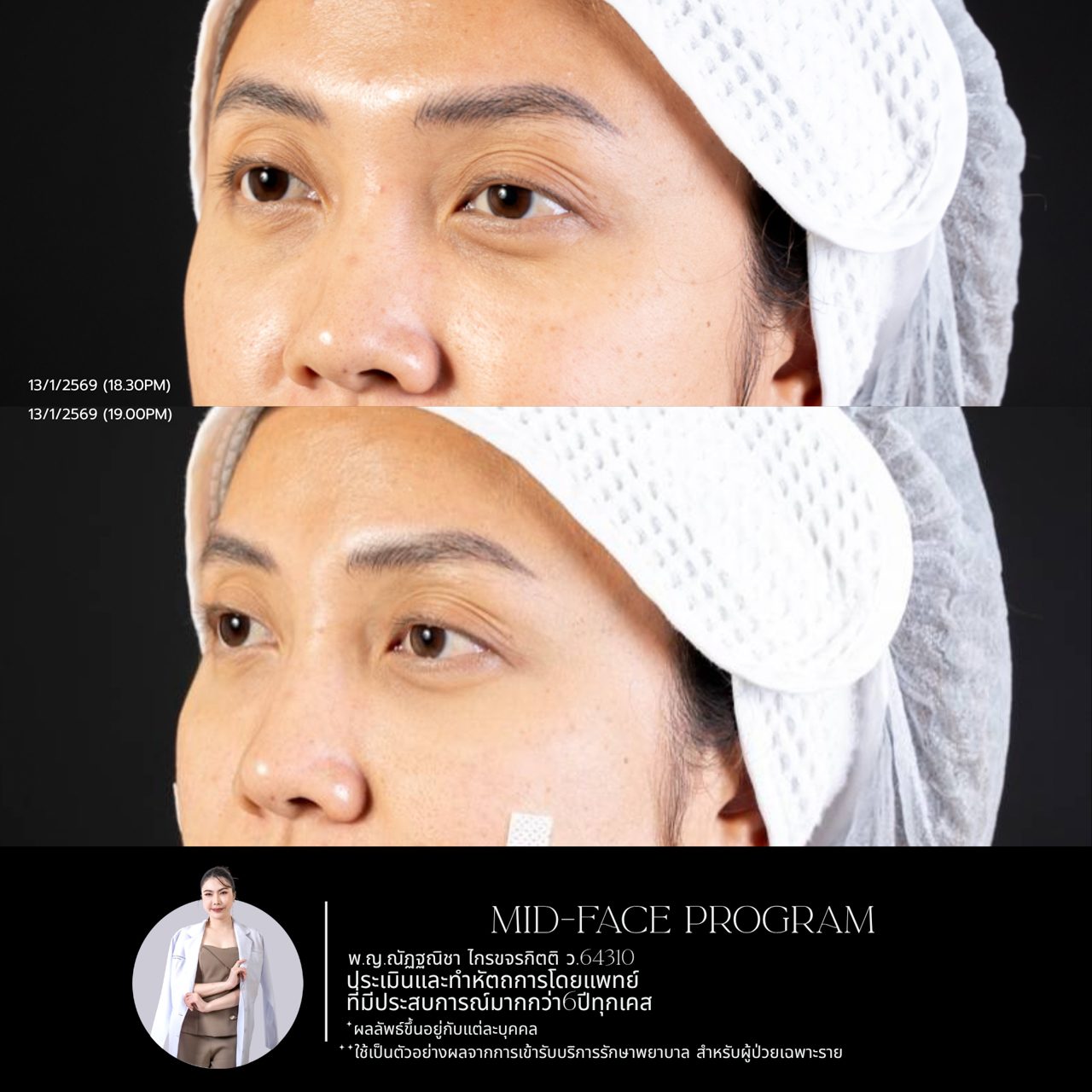 Filler ใต้ตา