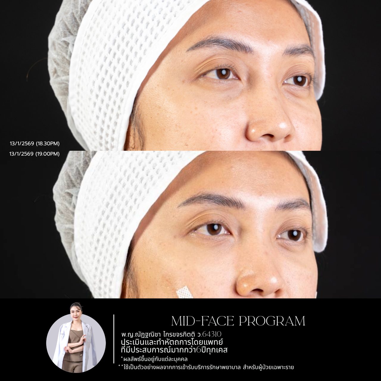Filler ใต้ตา