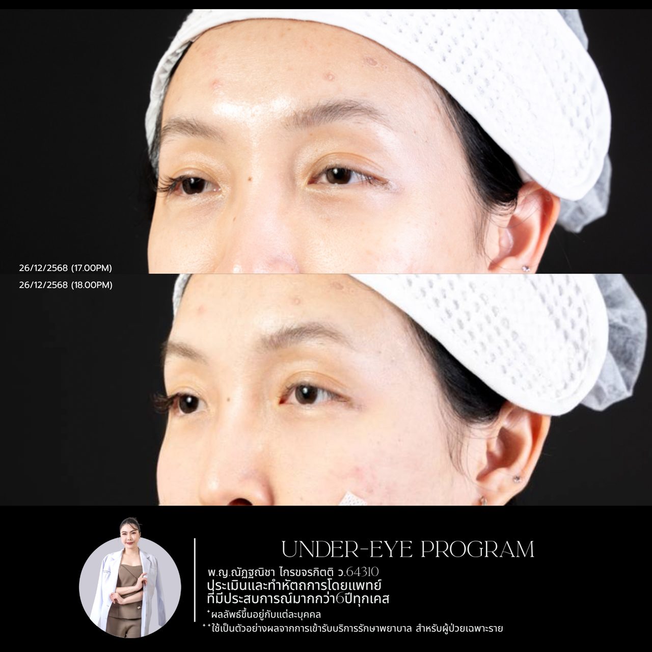 Filler ใต้ตา