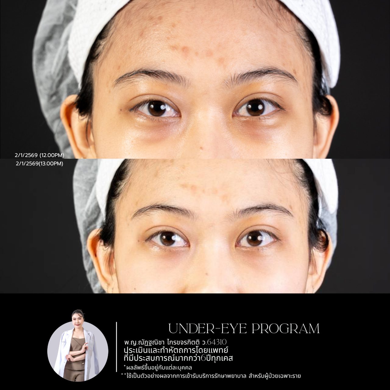 Filler ใต้ตา