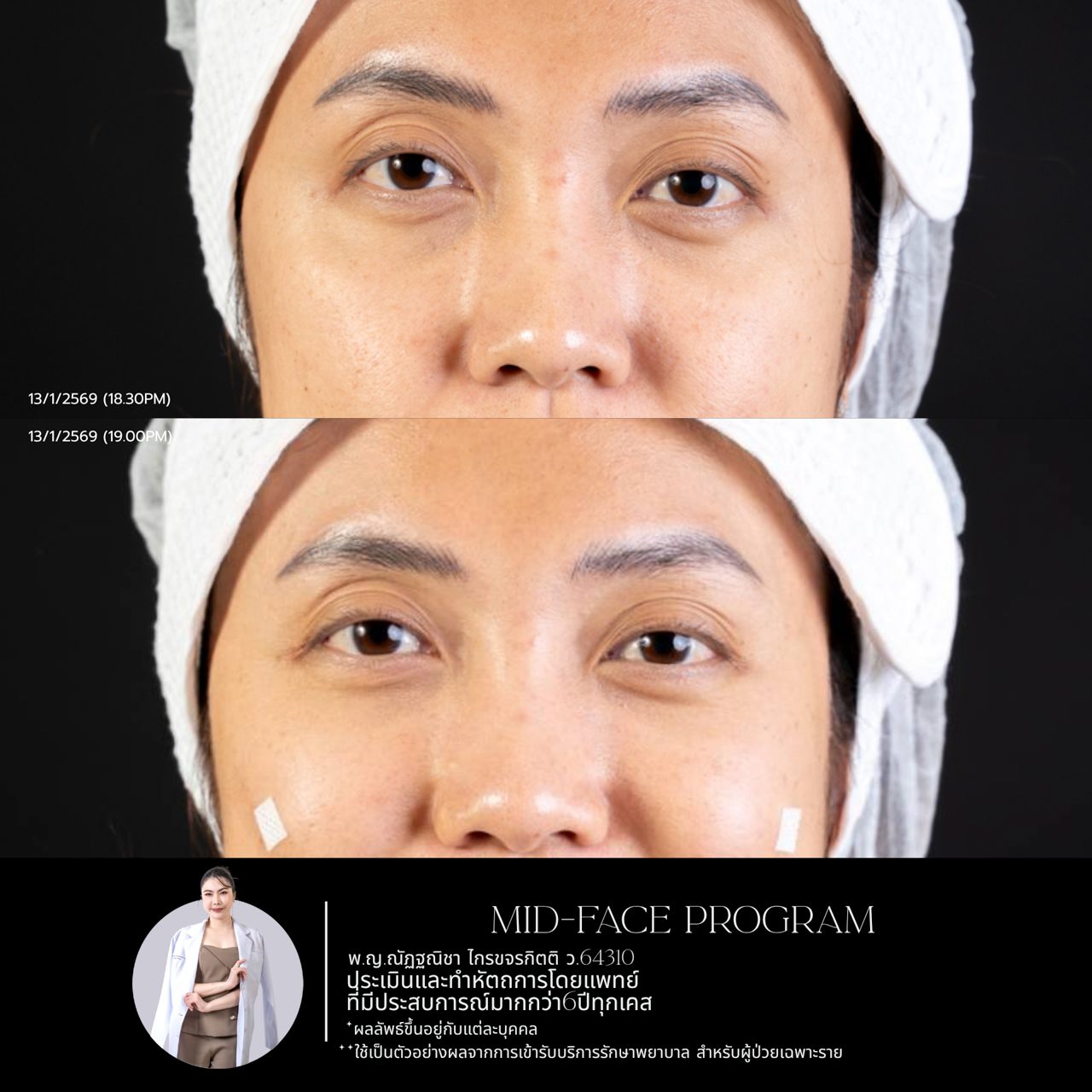 Filler ใต้ตา