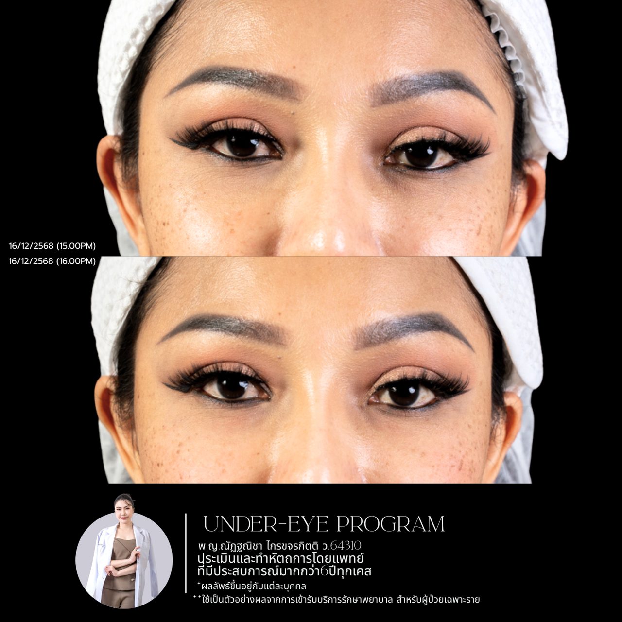 Filler ใต้ตา
