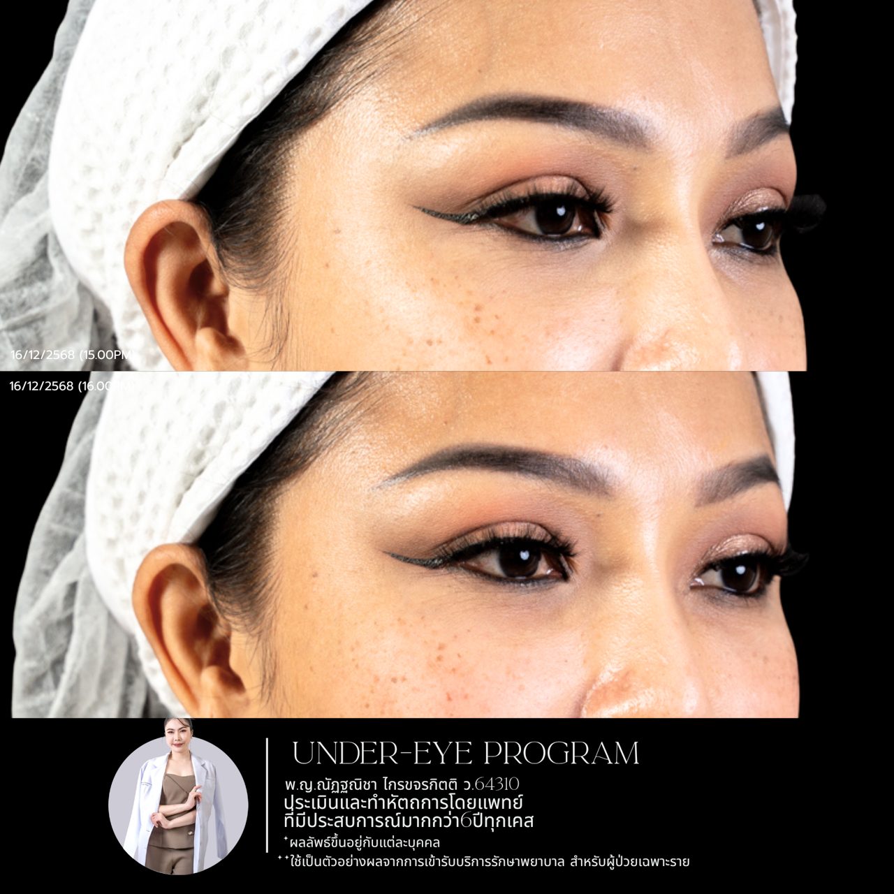 Filler ใต้ตา