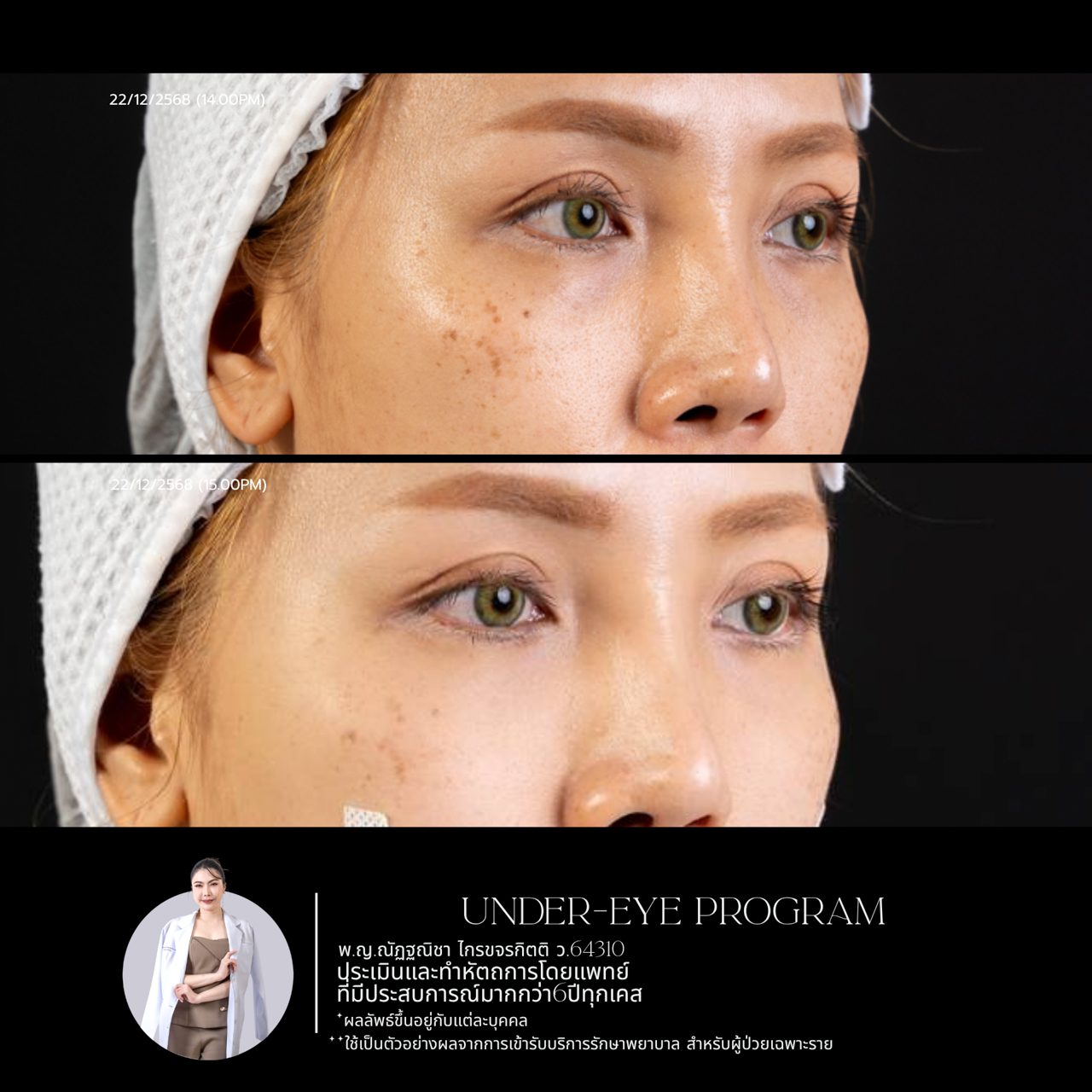 Filler ใต้ตา
