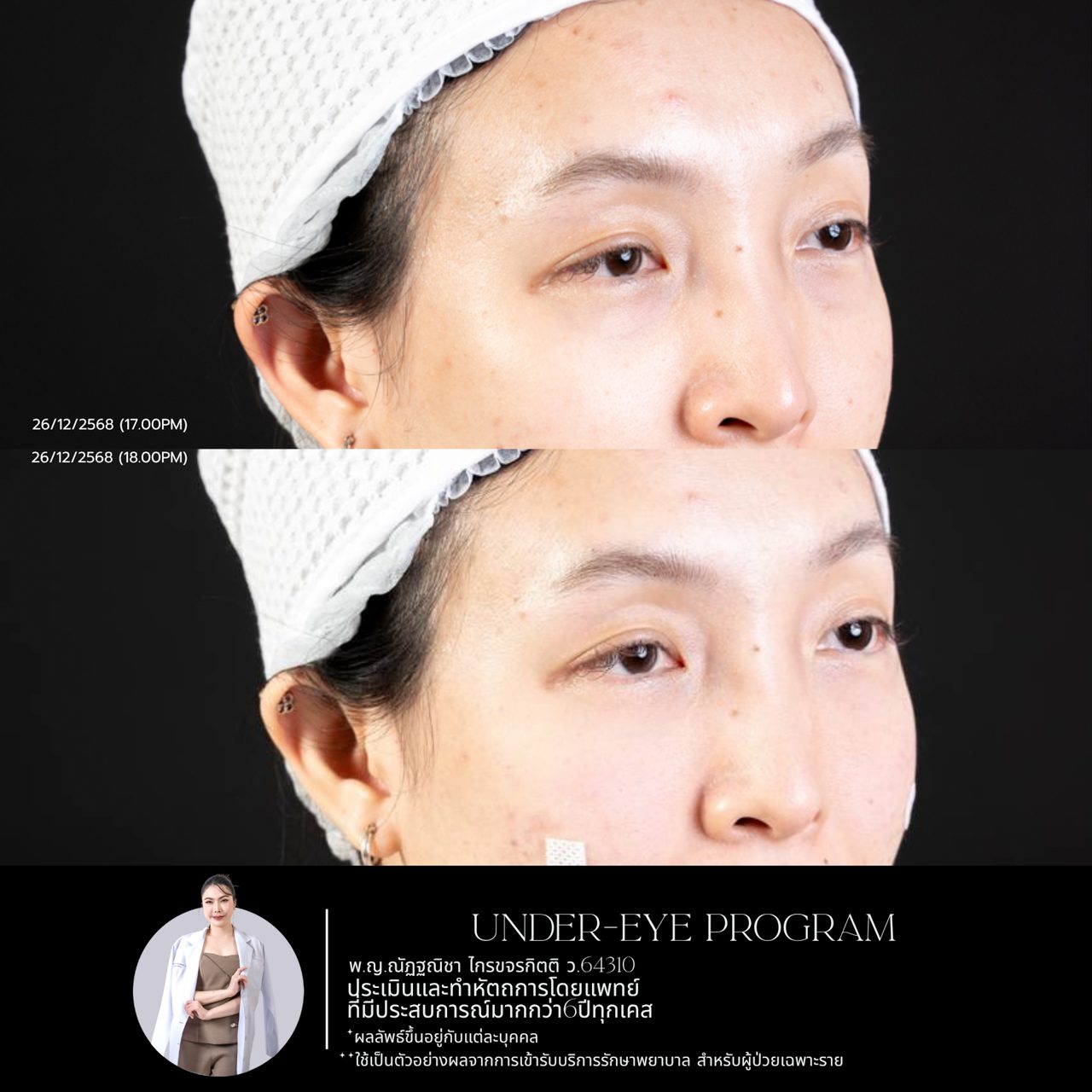 Filler ใต้ตา