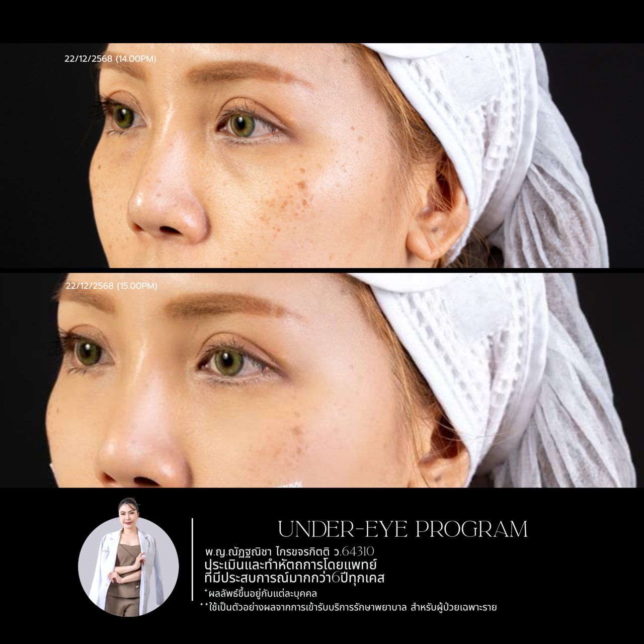 Filler ใต้ตา