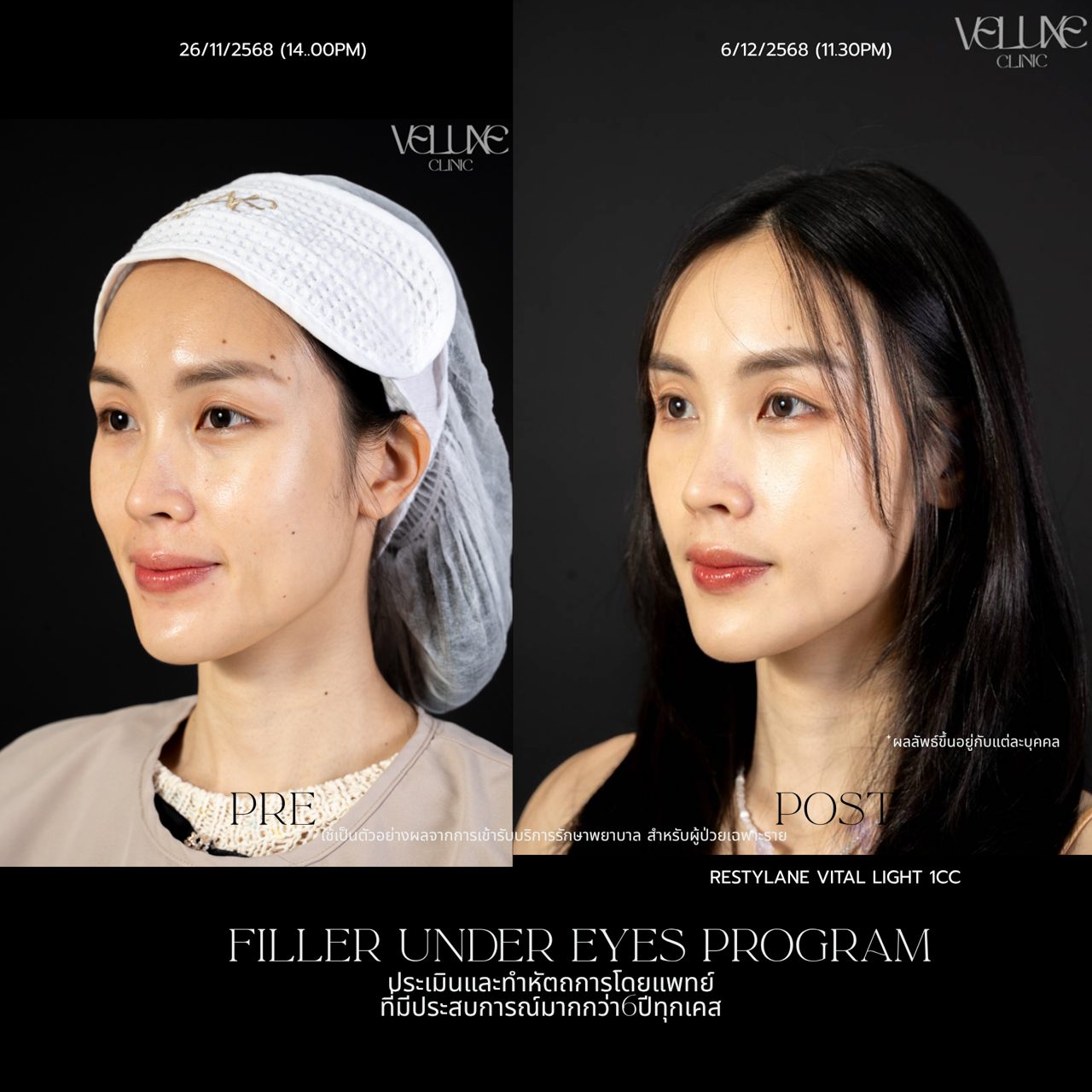 Filler ใต้ตา