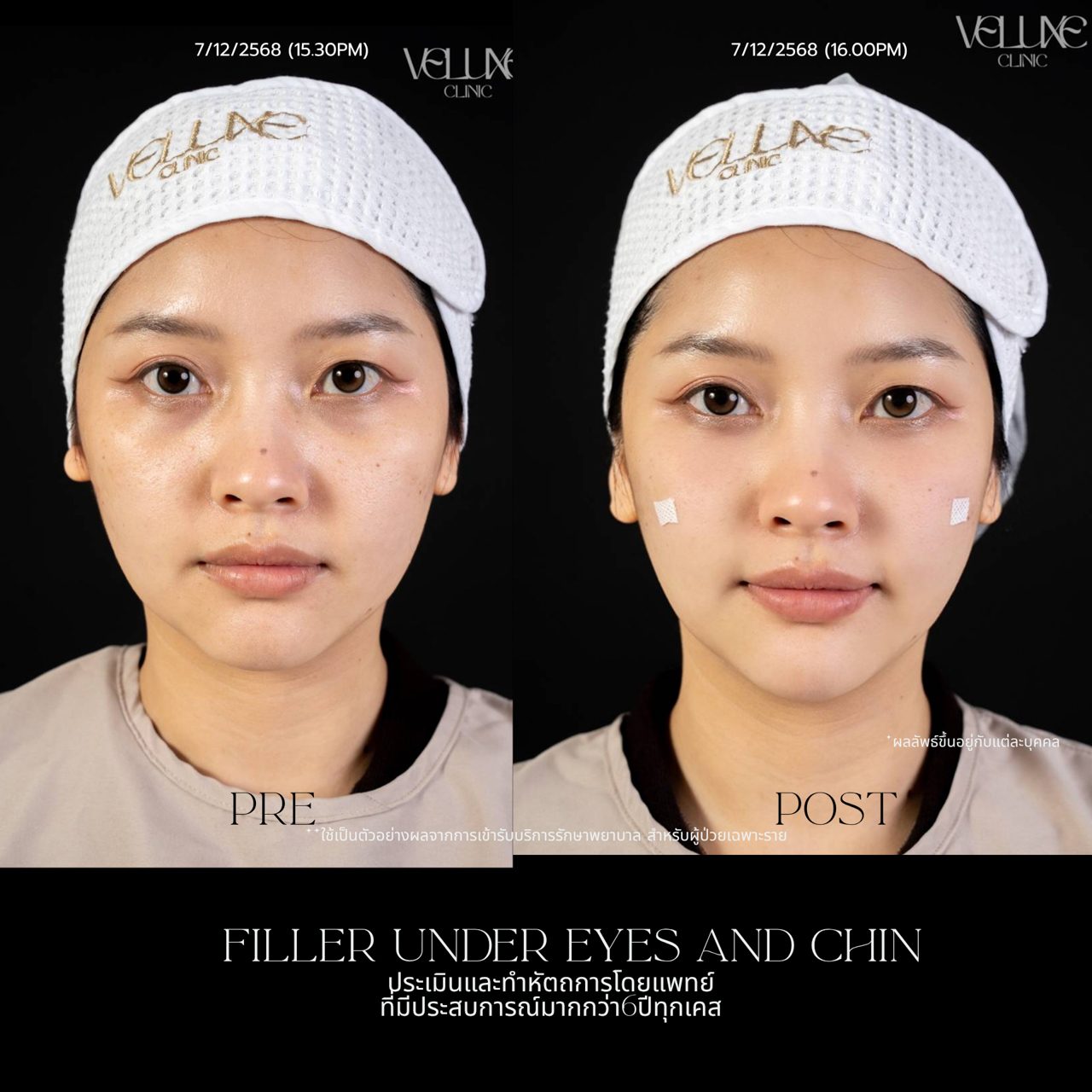 ภาพ Before-After ฟิลเลอร์ร่องตา