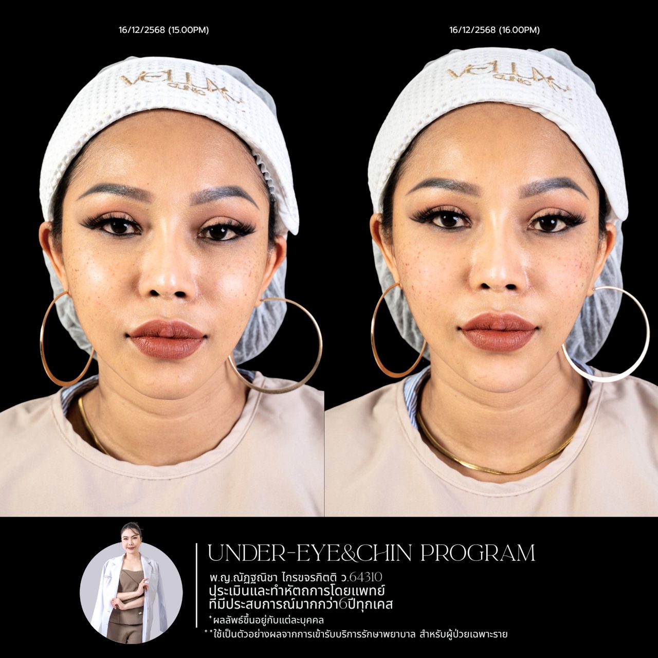 Filler ใต้ตา